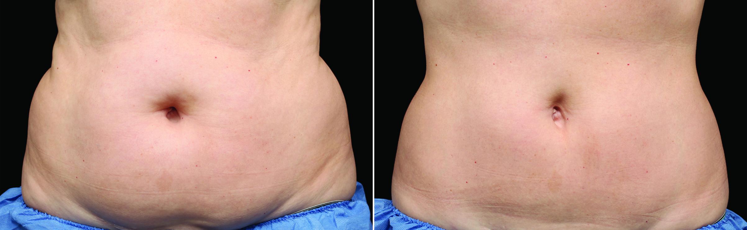 Patient 59024, CoolSculpting before and after pictures CoolSculpting before and after pictures in Melbourne, FL, Patient 59024